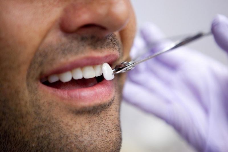 Ceramic veneers