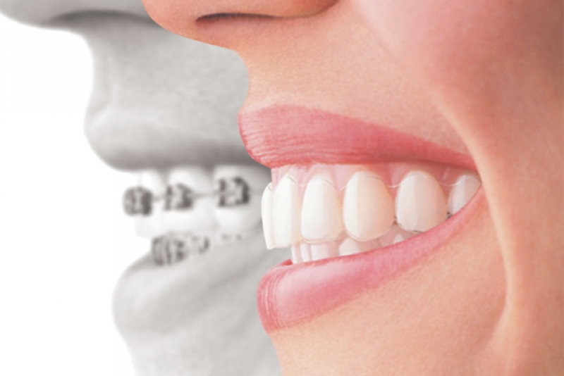Clear aligners
