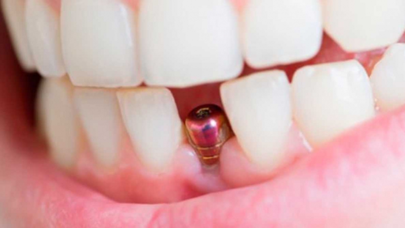 Dental Implants (Nobel Biocare)